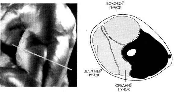 MR-1 разрез работы мышц трицепса при разгибании рук вниз с изогнутой рукояткой