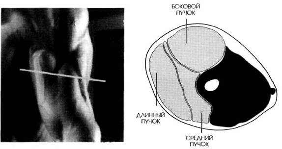 MR-1 разрез работы мышц трицепса при отжиманиях на брусьях с нейтральным хватом