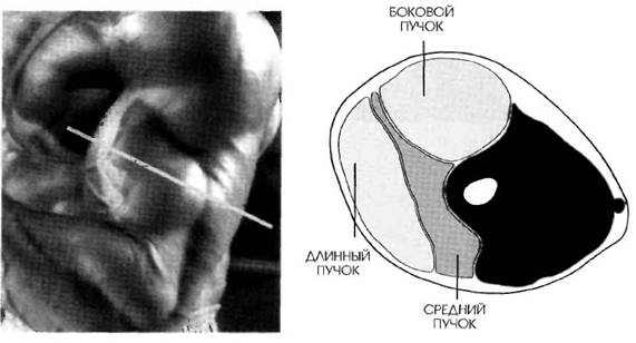 MR-1 разрез работы мышц трицепса при разгибании рук вниз с прямой рукояткой и узким хватом