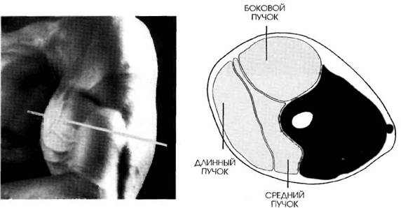 MR-1 разрез работы мышц трицепса при разгибании рук вниз с веревкой