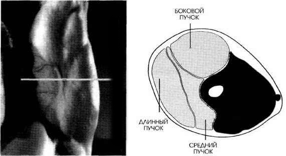 MR-1 разрез работы мышц трицепса при разгибании рук над головой с гантелями и вращением