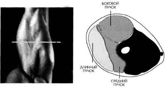 MR-1 разрез работы мышц трицепса при разгибании рук над головой alt=